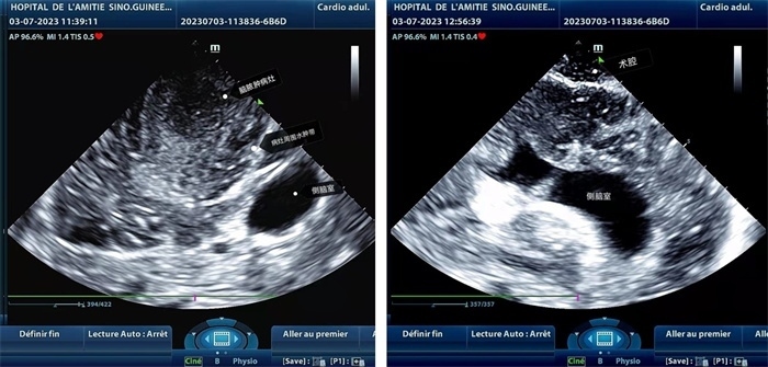左圖顯示術(shù)中超聲見(jiàn)囊實(shí)性病變，大小約為4x4x3cm，病灶周圍腦組織水腫明顯；右圖為病灶切除后，術(shù)中超聲示術(shù)腔無(wú)病變殘留