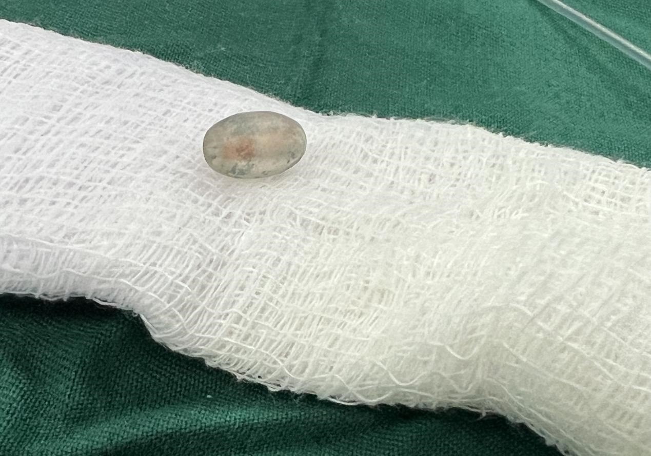 被取出的異物。中國(guó)援桑醫(yī)療隊(duì)供圖