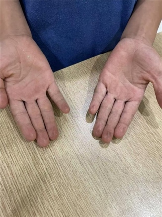 9歲小學(xué)生長期拍煙卡，手部粗糙長繭。受訪者供圖