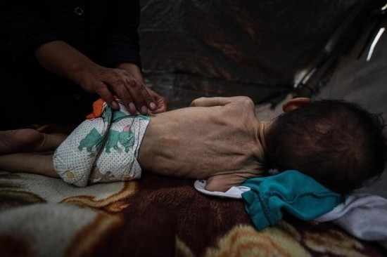 這是5月28日在加沙城西部一處臨時(shí)安置點(diǎn)拍攝的一名營(yíng)養(yǎng)不良的嬰兒。新華社發(fā)（馬哈茂德·扎基攝）